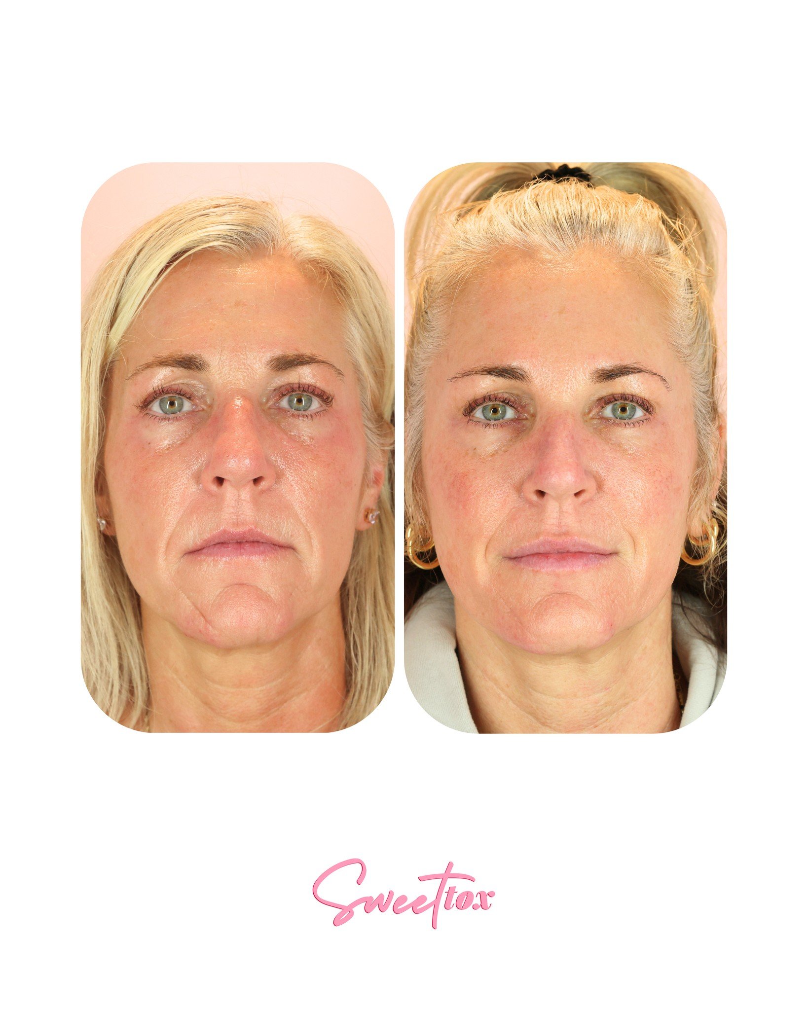 This is what a well thought out anti-aging PLAN looks like ✨ 

If you want to learn more about Sculptra (hint hint 😉 for Sculptra Day, April 15th) and what it did for this beautiful result, keep on reading!

👯&zwj;♀️ Meet one of our favorite long-g