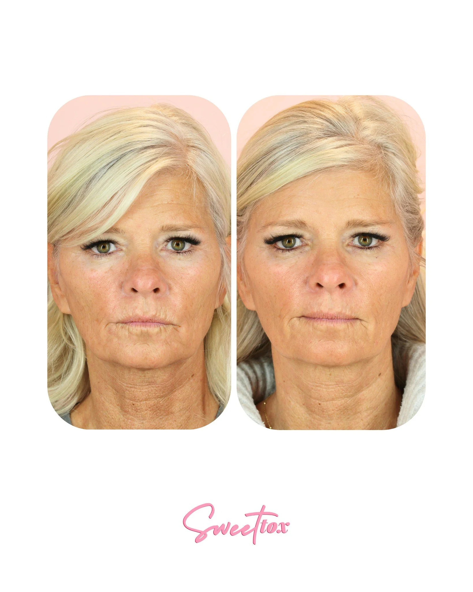 ✨The Injectable Trifecta - Sculptra + Dysport (Tox) + Filler ✨

Here's what that actually means👇

This result didn't happen overnight, and that's exactly the point!

𝔻𝕪𝕤𝕡𝕠𝕣𝕥 (aka tox) was used to relax the muscles contributing to lines around