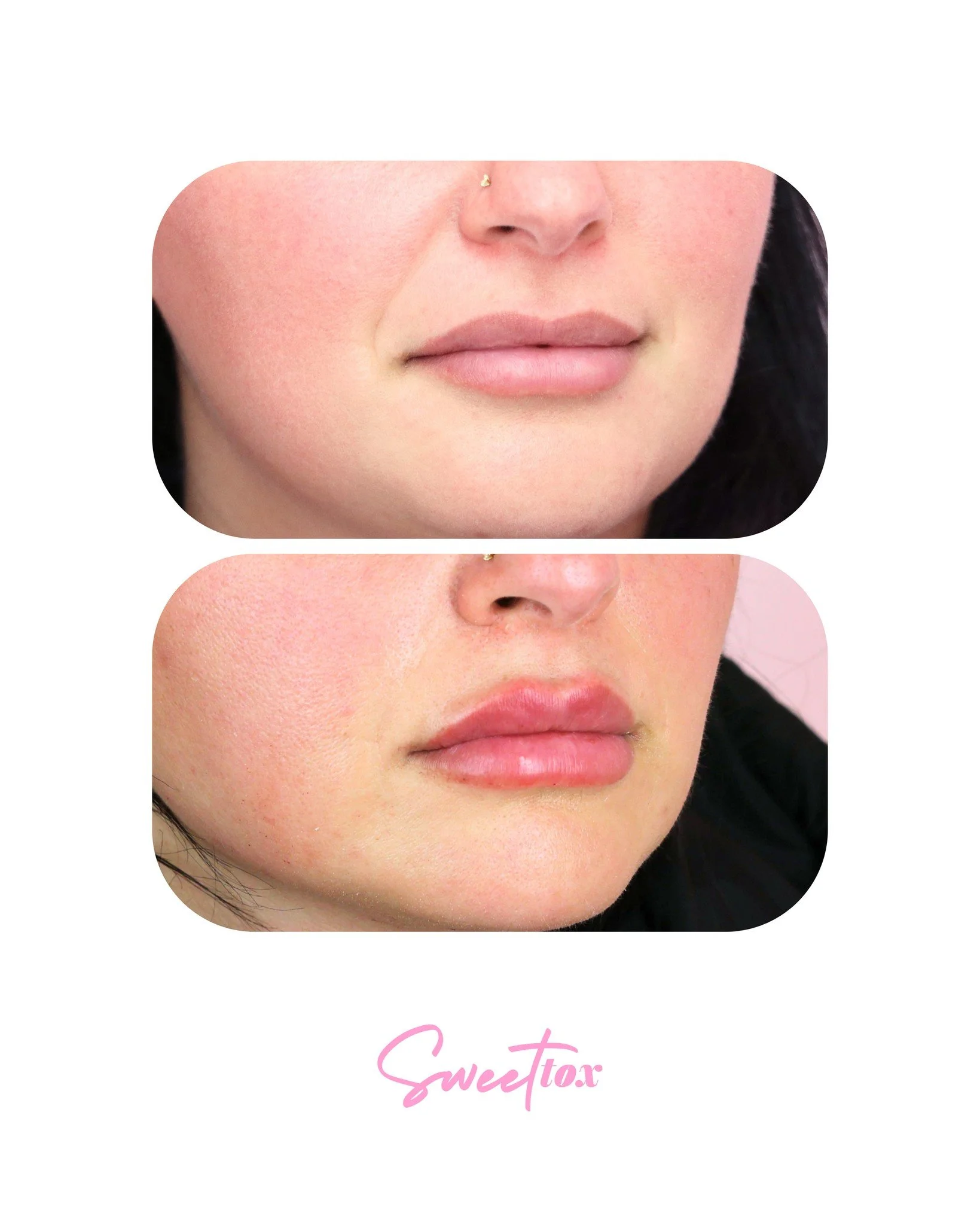 This is what 6 years of lip filler maintenance looks like on a long time loyal patient😍

Our patient started with us in 2020 and has never skipped a beat, coming in every 6-8 months for lip filler to preserve her results and keep her lips plump and 