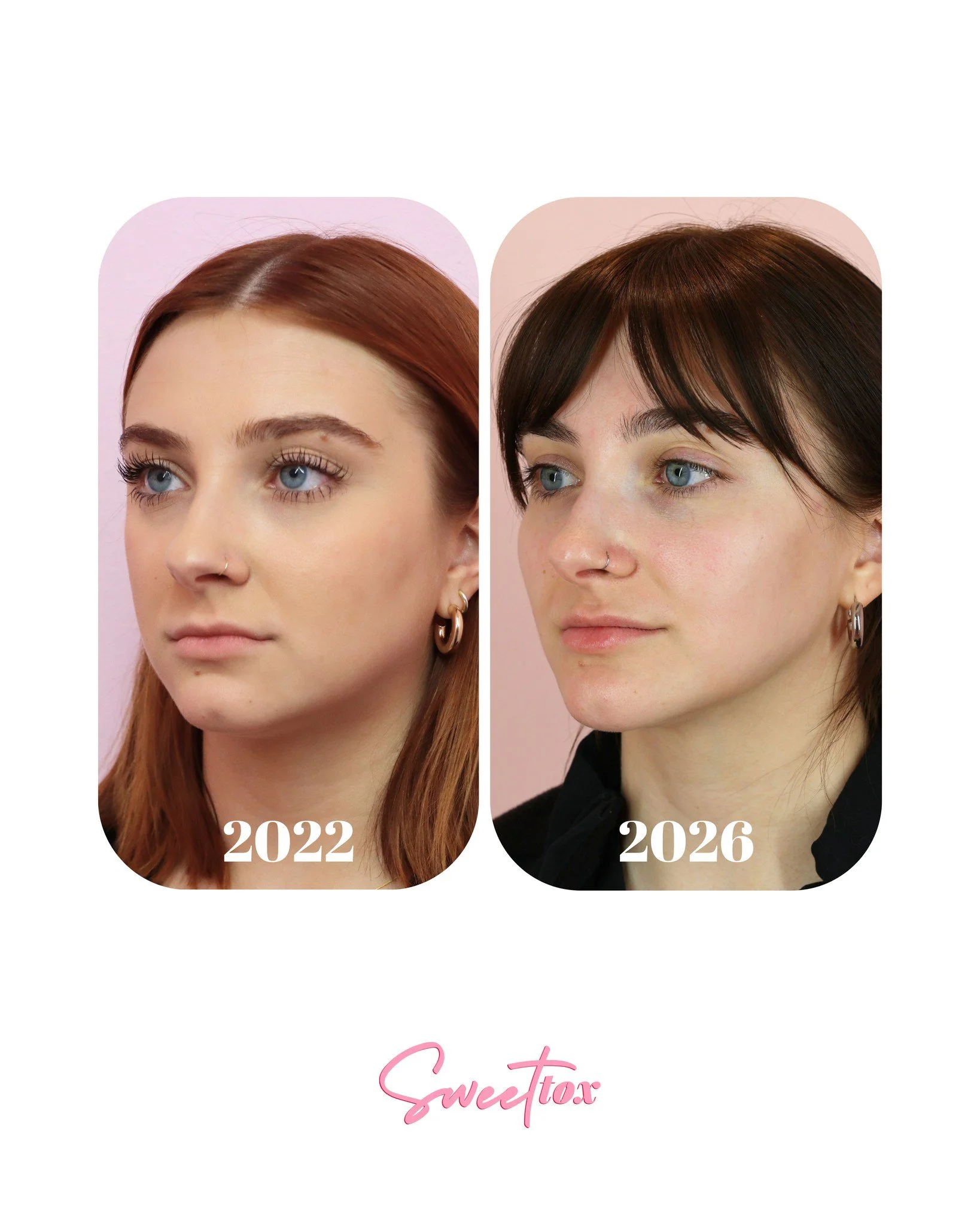 Hi friends, it's me Emma &mdash; and what you're looking at is my very own before and after! Time truly FLIES when you're having fun, and what a journey this has been. 🥹✨

You're probably wondering what I've done from 2022 to now. I'm all about tapp