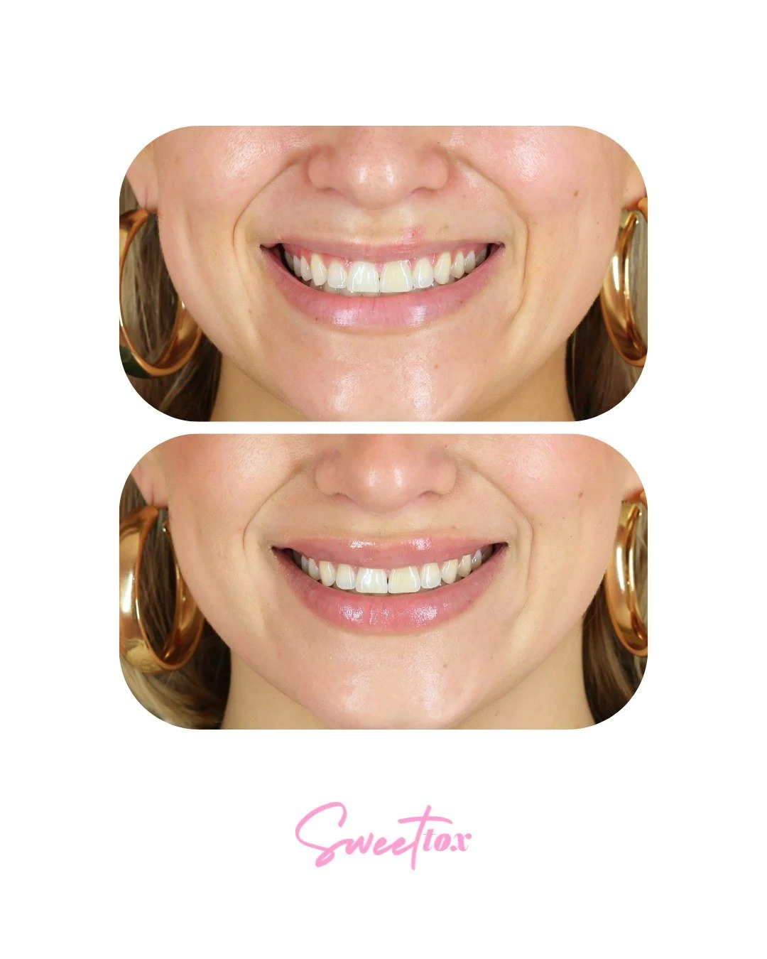For everyone whose upper lip vanishes the second they smile&hellip; this one's for you 🙋&zwj;♀️👄

Here's the breakdown of these stunning results utilizing both tox &amp; filler!

💉 Lip Flip (6 units)
We use tox (Botox/Dysport) to relax the muscle 