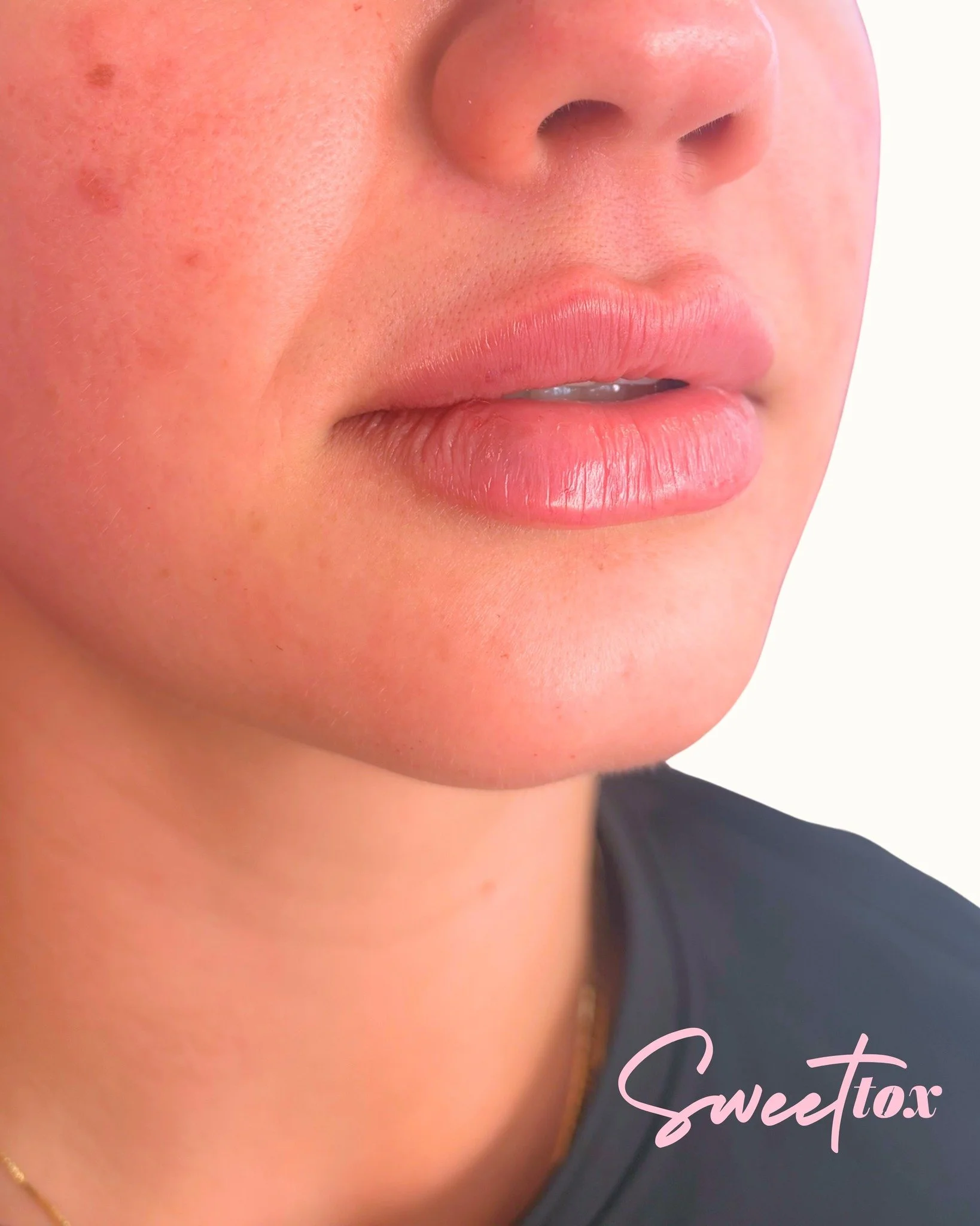Cutie lips on a cutie gal 😙

‼️ 🧐 Did you know we carry over 15 different filler products!? Our skilled injectors pick the best products just for you- all based on your individual anatomy, goals &amp; any previous filler experiences. That way we're