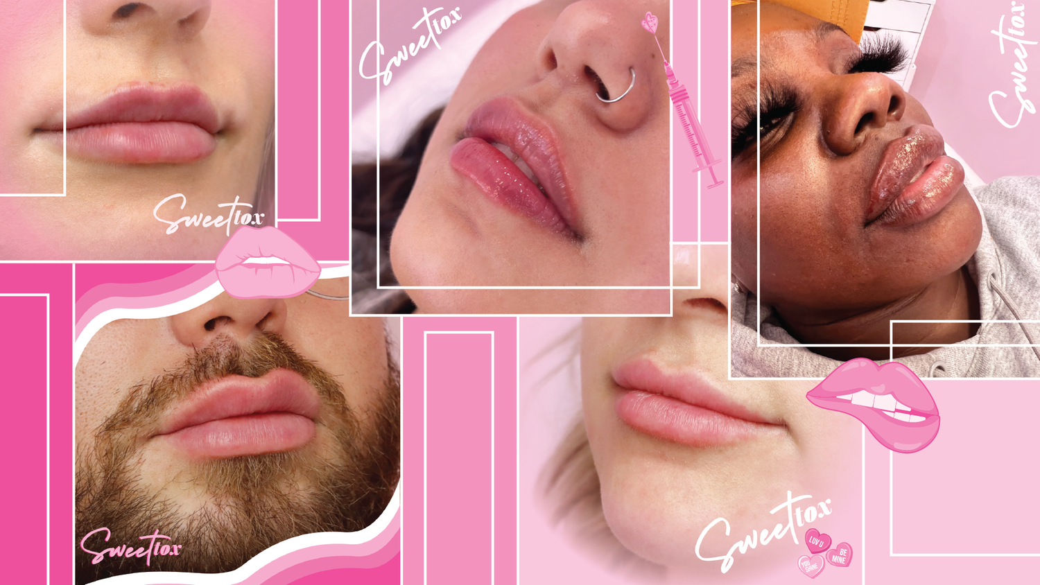 Lip Injections in Milwaukee, WI Sweet Tox — Sweet Tox