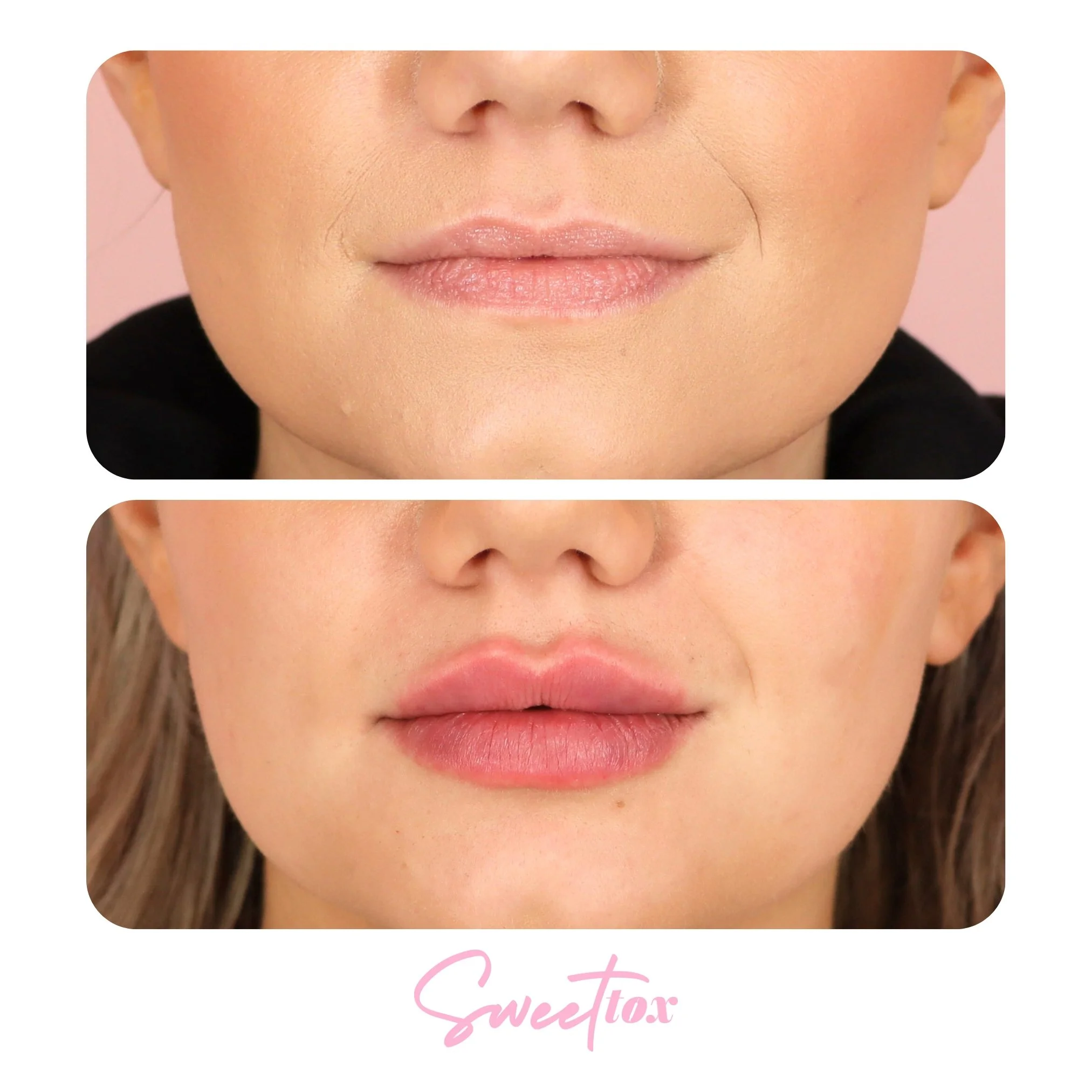 Best Lip Injections and Lip Filler in Milwaukee, WI | Sweet Tox — Sweet Tox