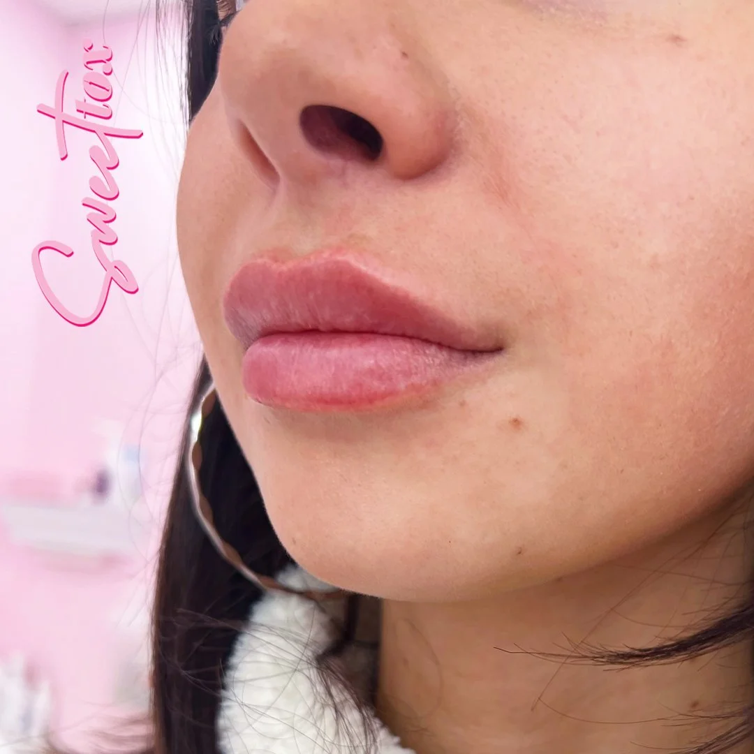 Lip Injections in Milwaukee, WI Sweet Tox — Sweet Tox