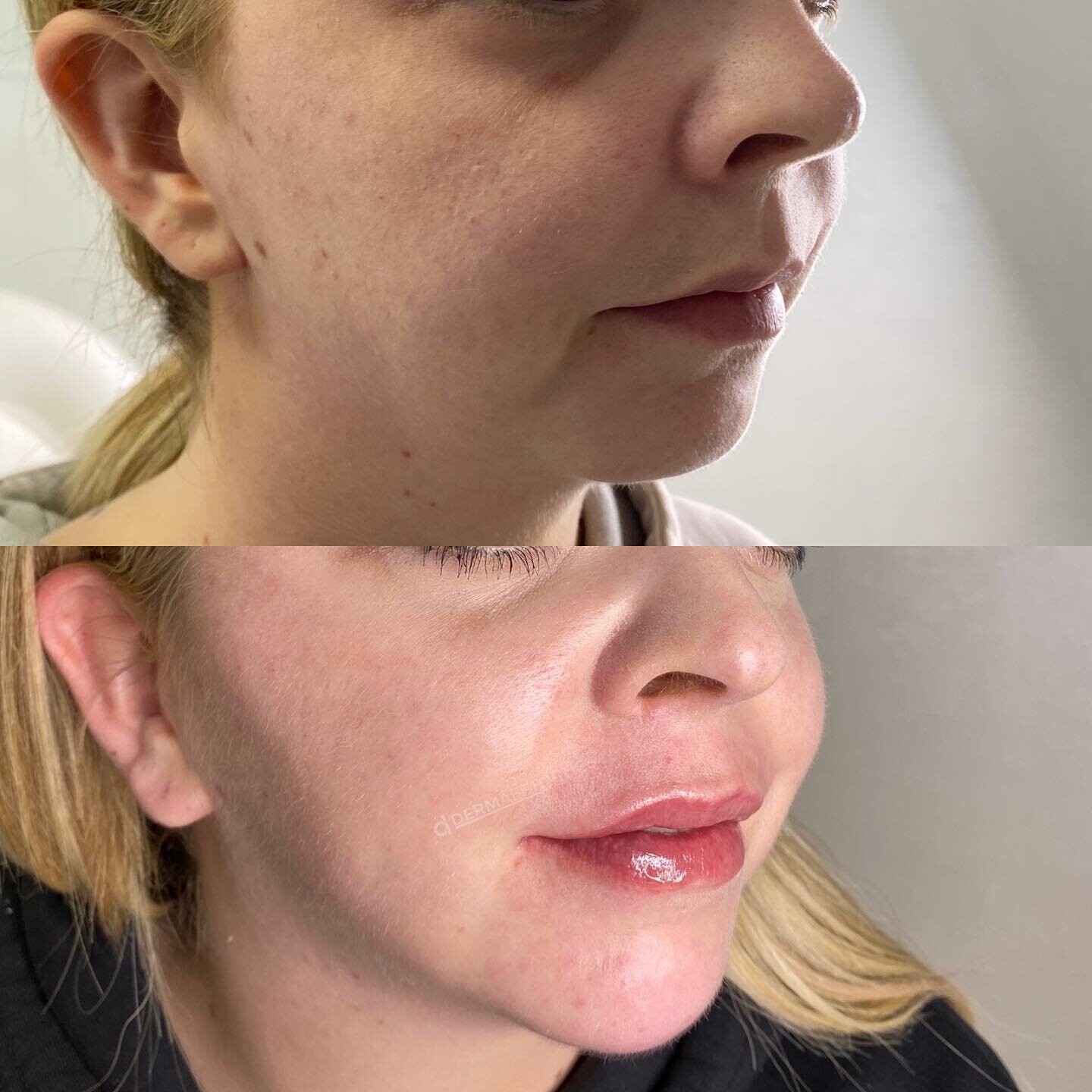 A complicated procedure adding structure to this clients face following extensive surgery which included bone manipulation and the installation of metal work.

An in-depth assessment was carried out in order to establish where was treatable and where
