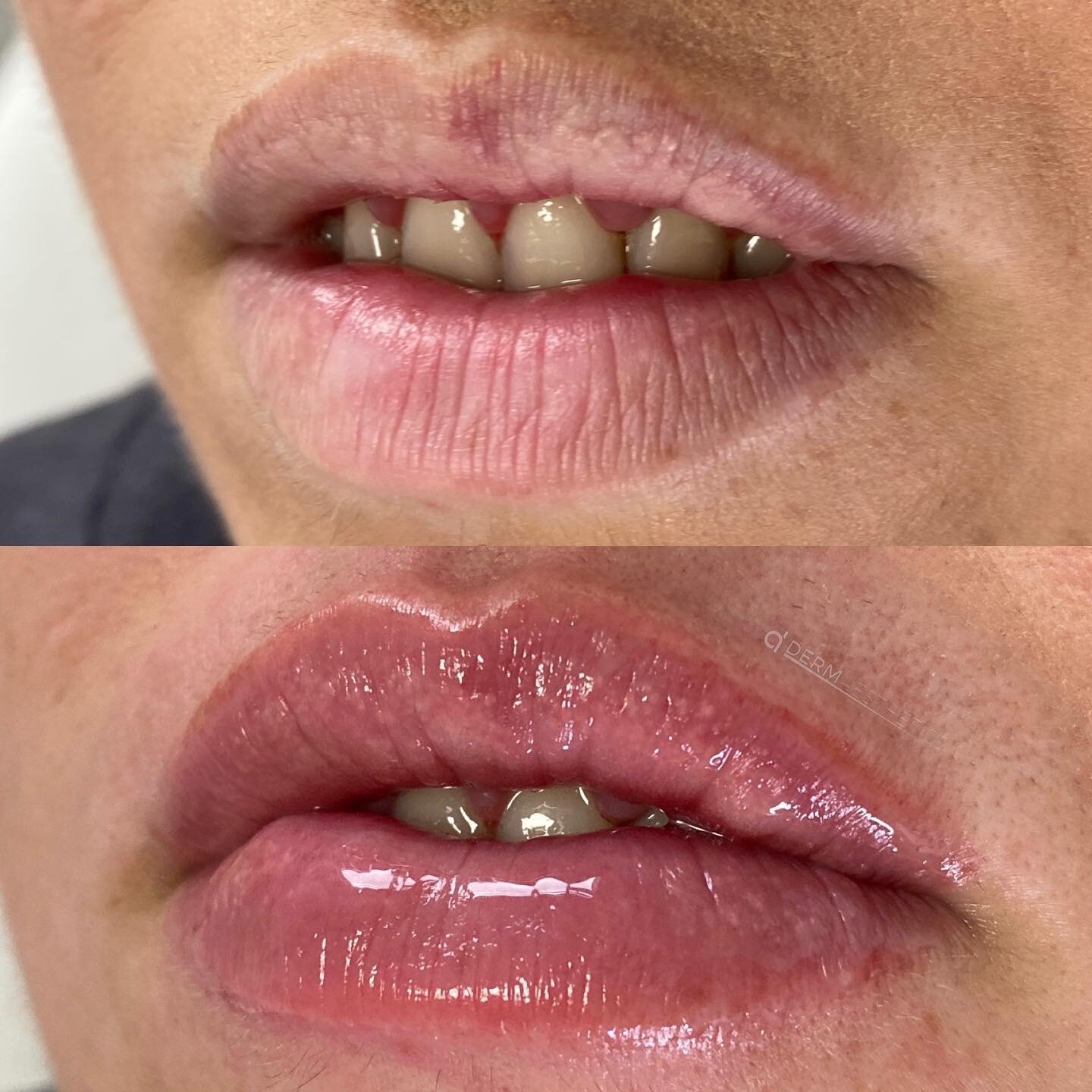 Lip augmentation, volume balancing and vermillion border enhancement 💉