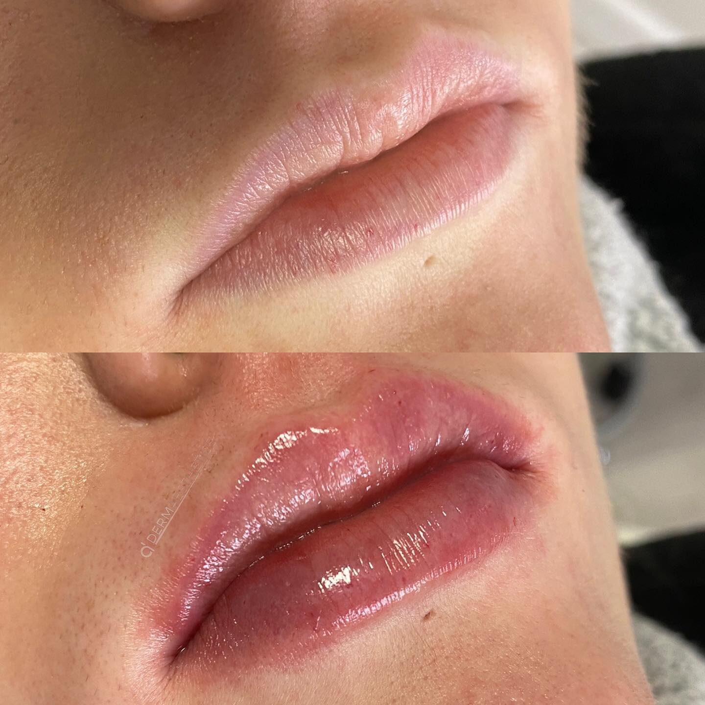 Lip augmentation and vermillion border enhancement 💉
