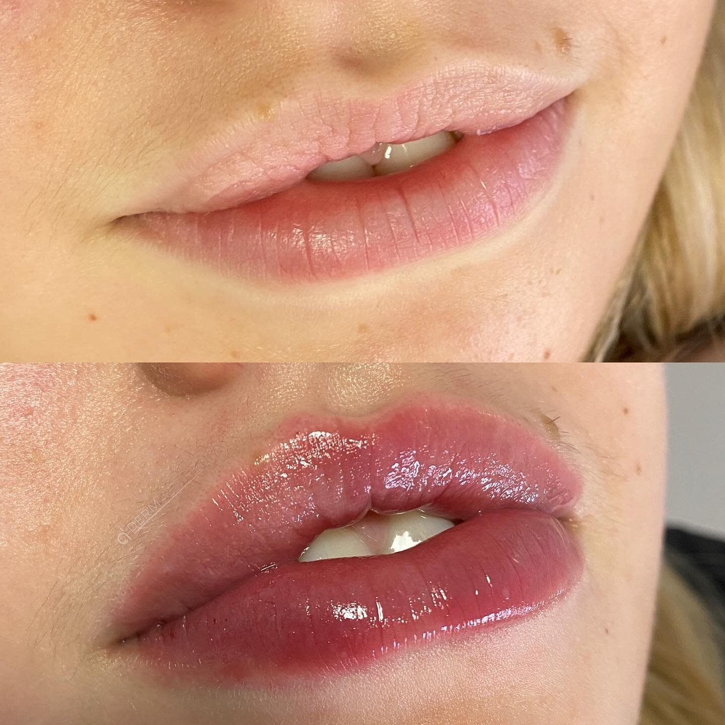 Lip augmentation, volume balancing and vermillion border enhancement 💉