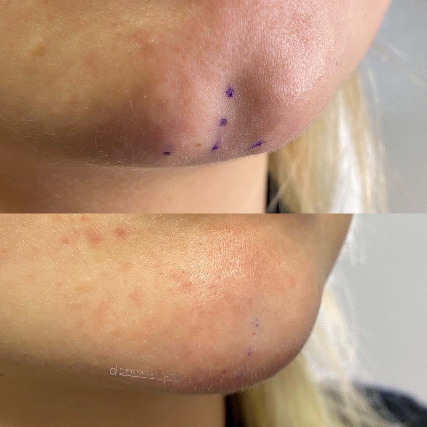 Liquid mentoplasty and cleft chin revision 💉