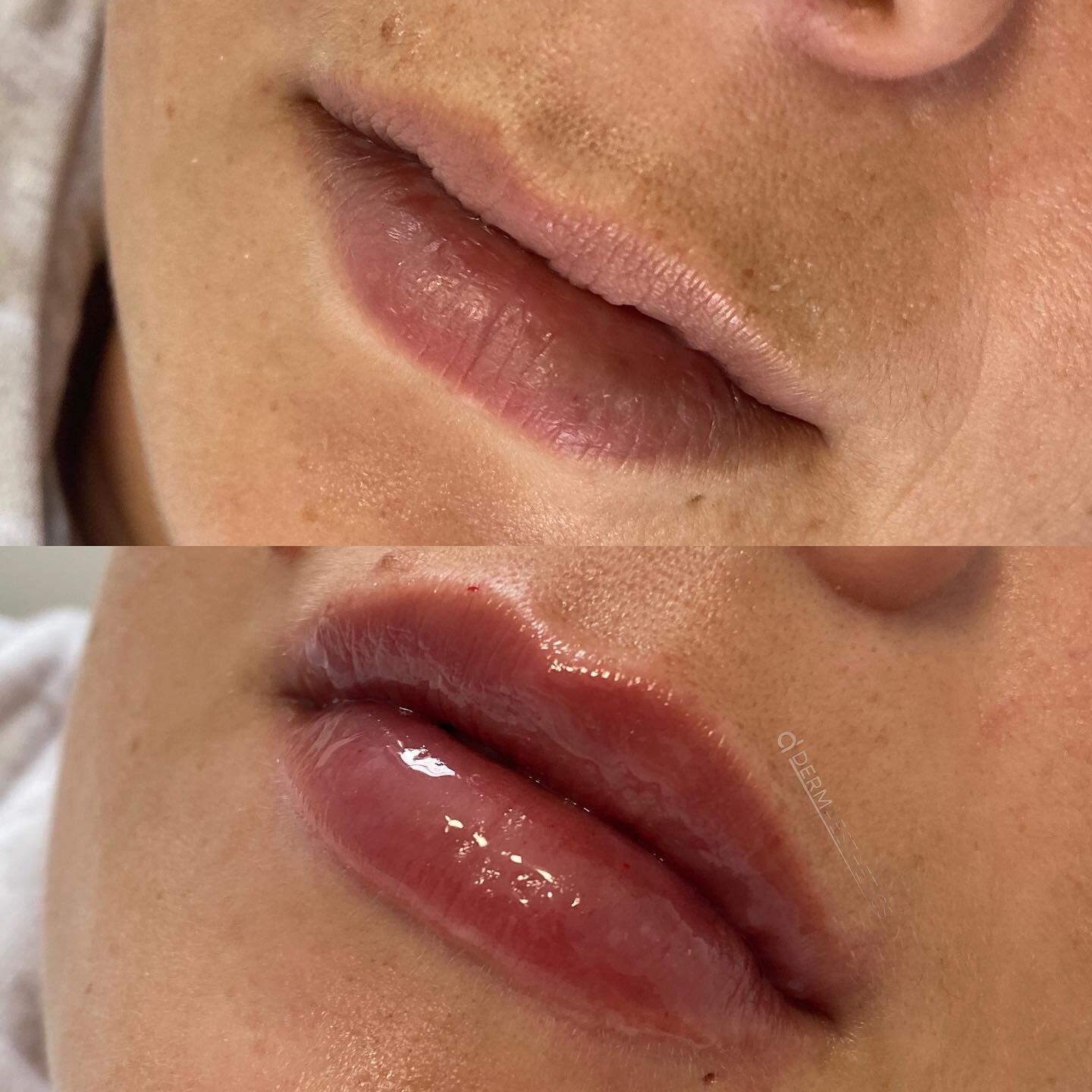 Lip augmentation, volume balancing and vermillion border enhancement 💉