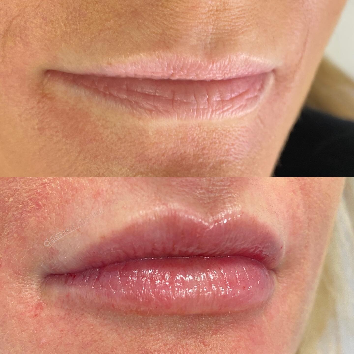 Subtle lip augmentation, volume balancing, vermillion border enhancement and shape revision 💉