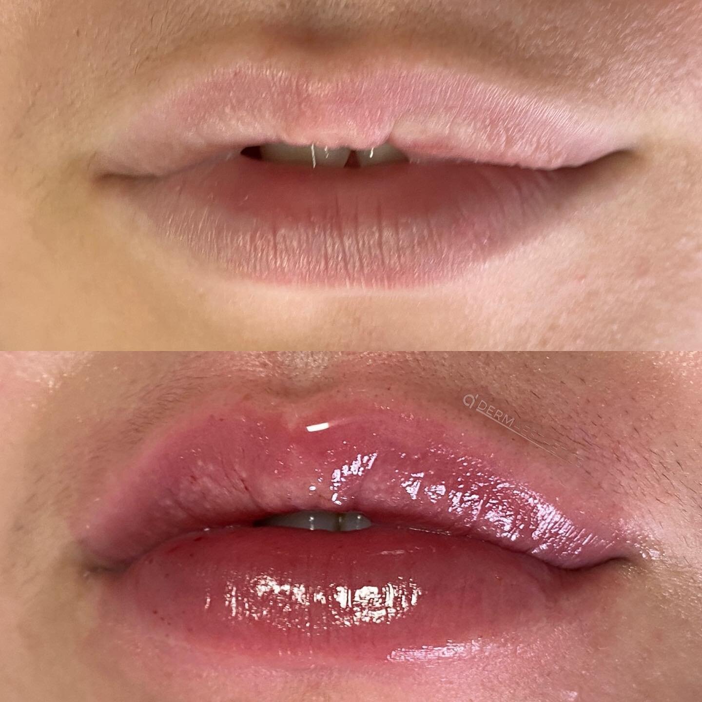Lip augmentation, volume balancing and vermillion border enhancement 💉