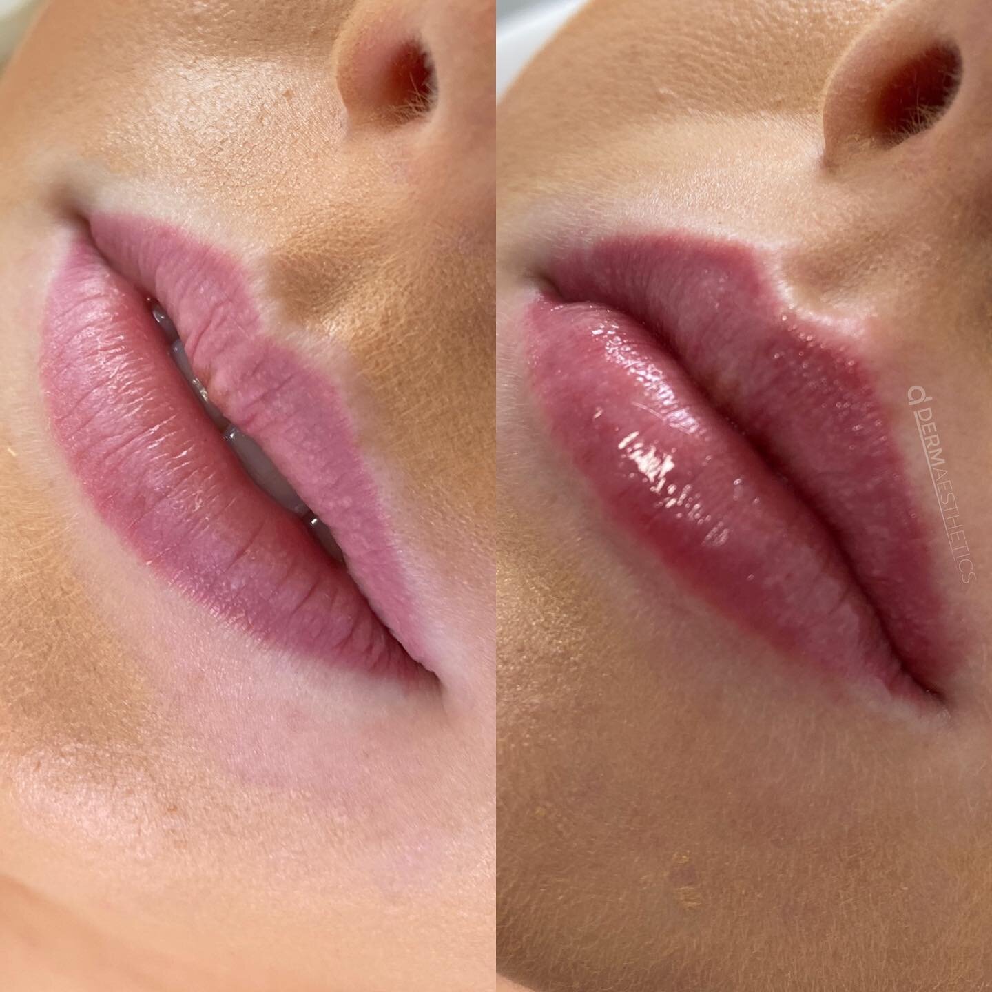 Lip augmentation, volume balancing, vermillion border enhancement and shape revision 💉