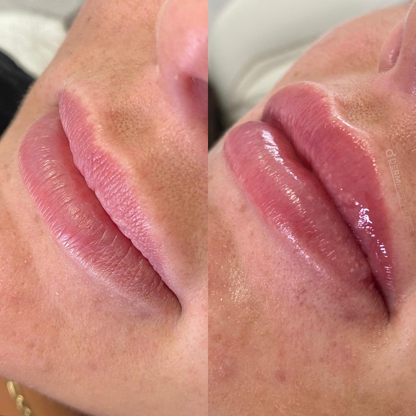 Lip augmentation, volume balancing and vermillion border enhancement 💉