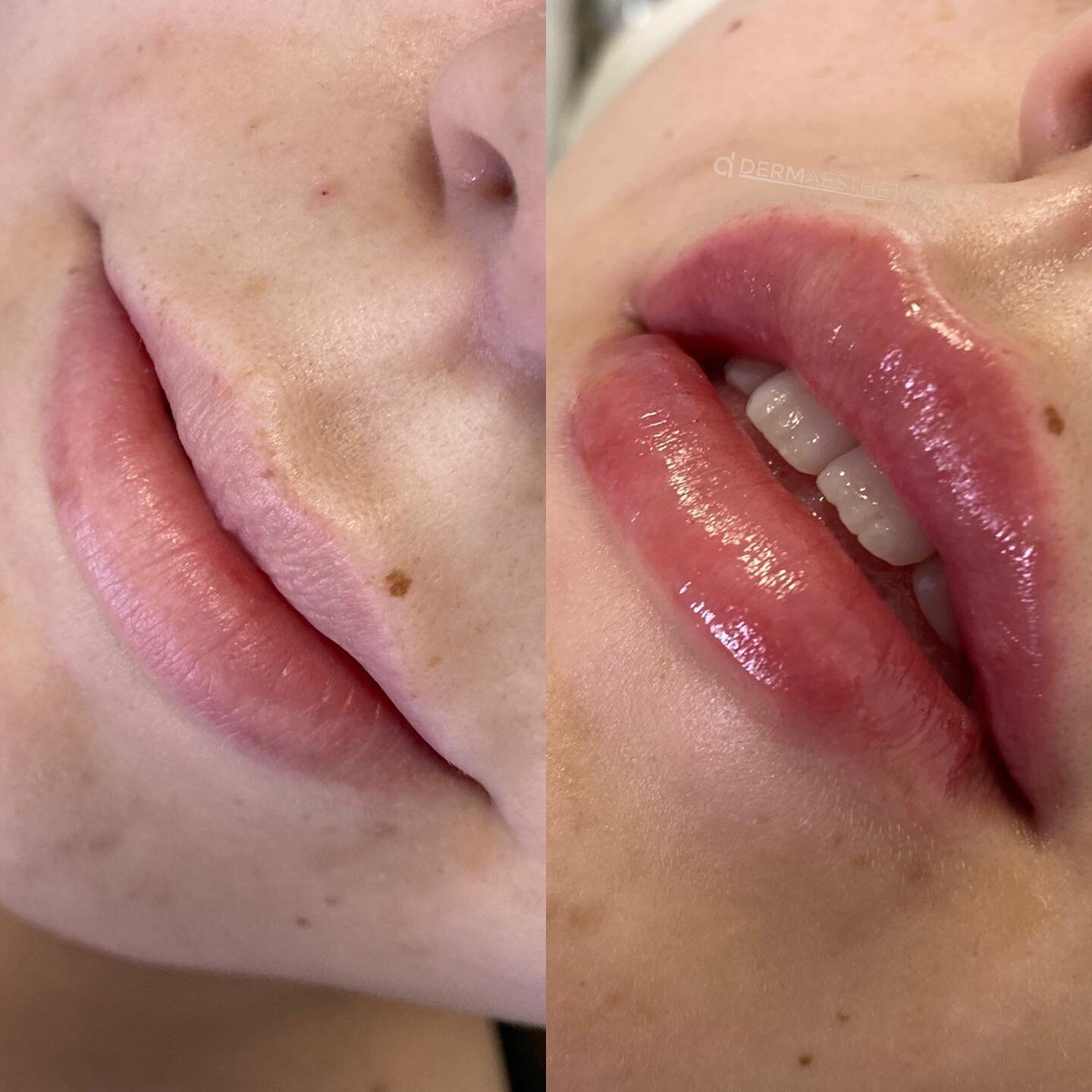 Lip augmentation, volume balancing and vermillion border enhancement 💉