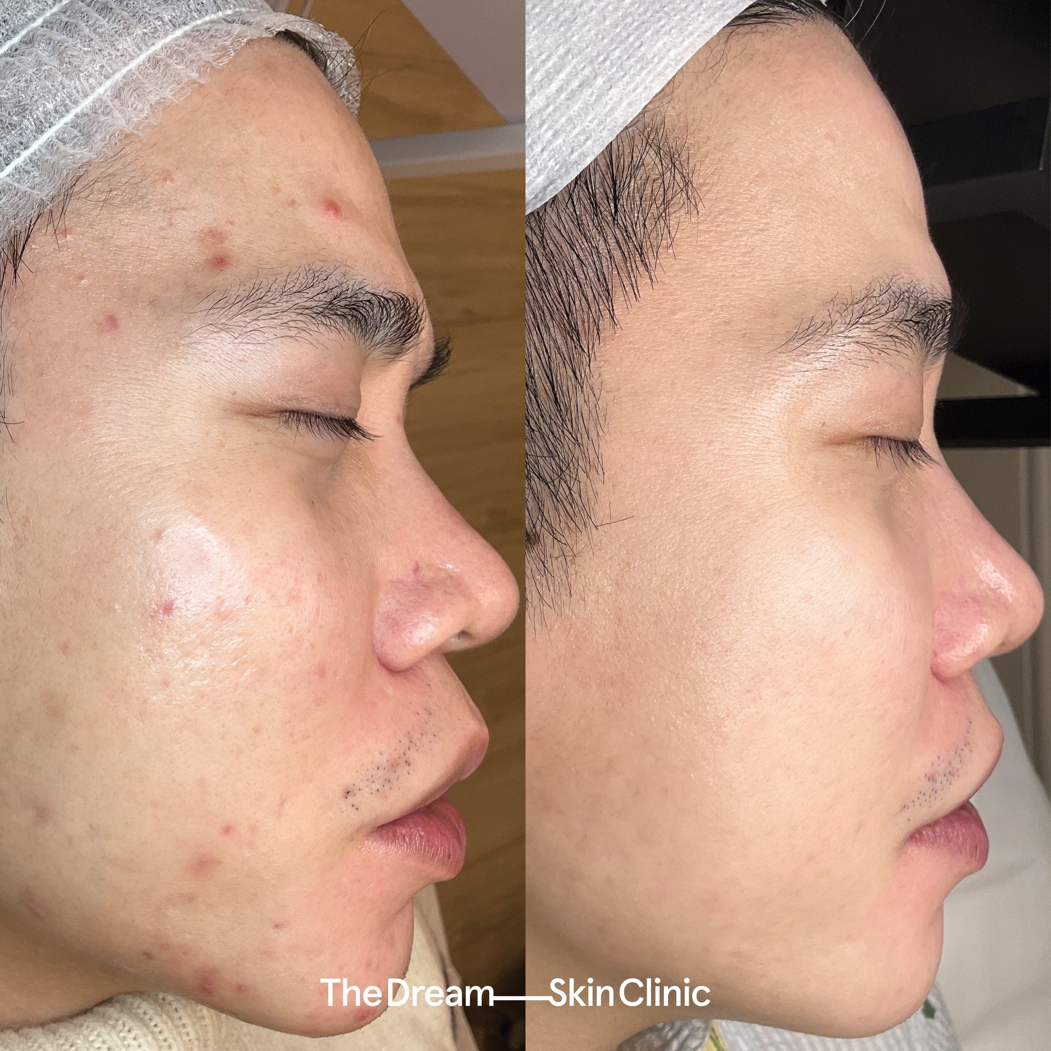 This client&rsquo;s concerns were:
∙ Pigmentation 
∙ Congestion 
∙ Scarring

Elevate your skin. Book a consultation using the link in our bio and get started on your skin journey with The Dream Skin Clinic!

*These photographs were captured and share