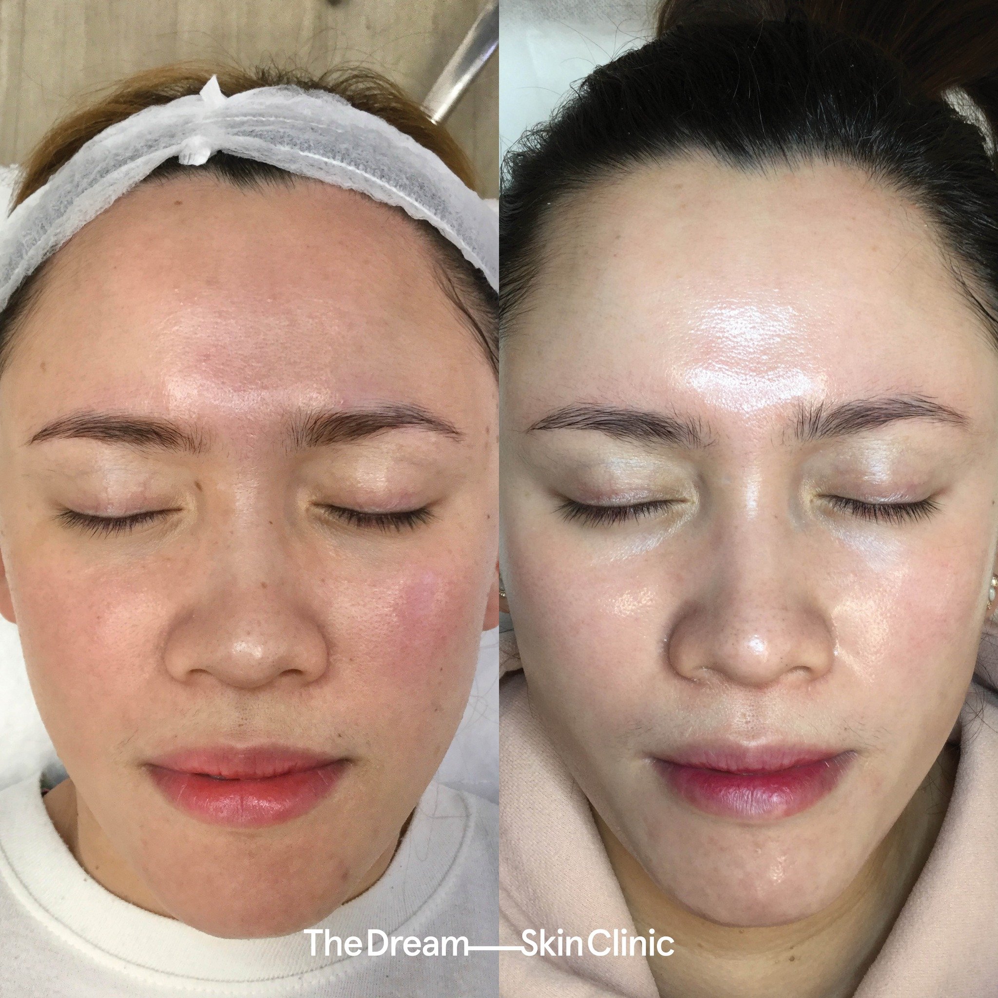 This client&rsquo;s concerns were:
∙ Texture
∙ Dull Skin
∙ Sensitivity

In achieving skin like this, the Dream Team plays a valuable role in helping you attain glass skin by providing professional guidance, personalised treatments, and access to adva