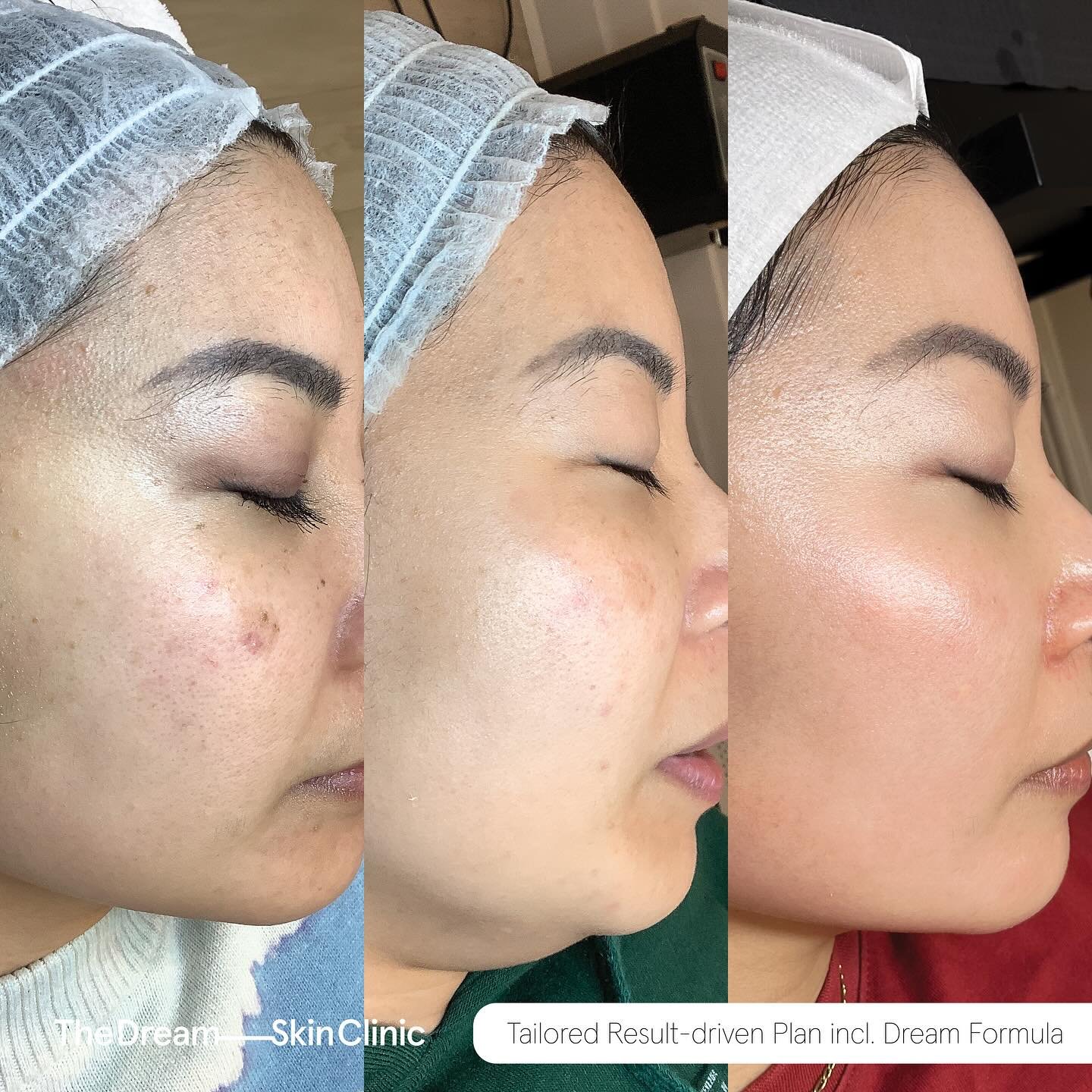 This client&rsquo;s concerns were:
∙ Dullness
∙ Pigmentation
∙ Uneven skin tone 

Book a skin consultation using the link in our bio and get started on your skin journey with The Dream Skin Clinic!

*These photographs were captured and shared with cl