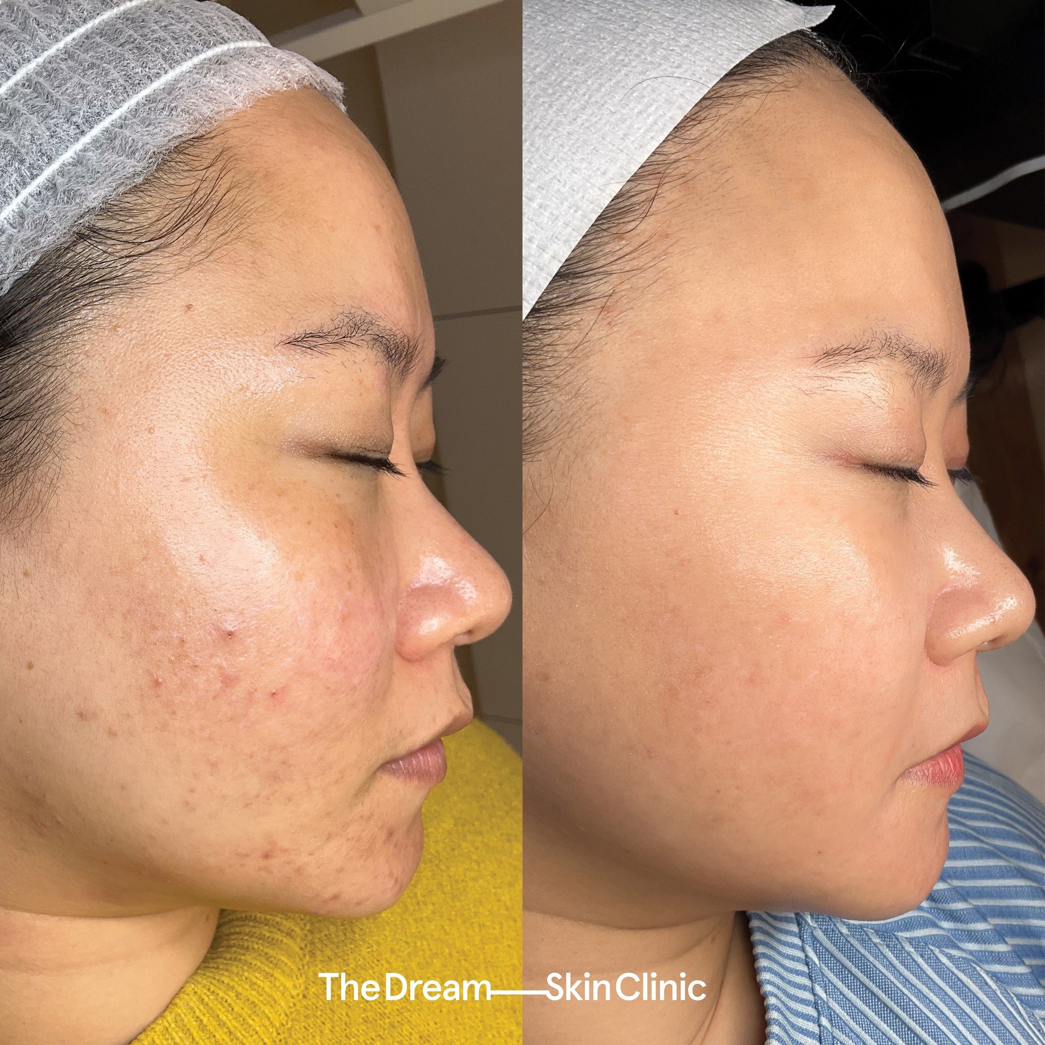 This client&rsquo;s concerns were:
∙ Congestion
∙ Pigmentation
∙ Scarring

Book a skin consultation using the link in our bio and get started on your skin journey with The Dream Skin Clinic!

*These photographs were captured and shared with client co