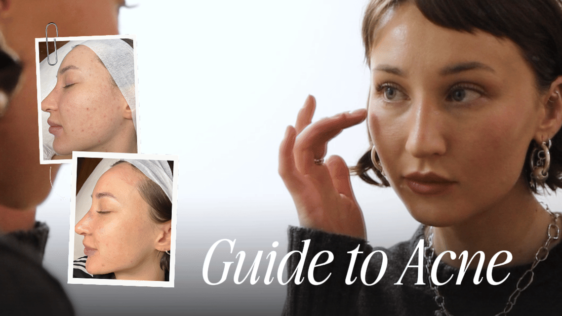 All About Acne: What It Is, What Causes It and How to Manage It