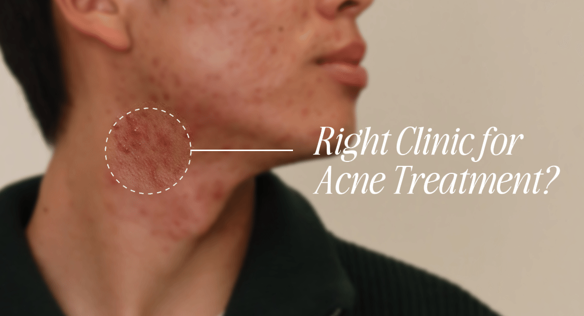 How to Choose the Right Skin Clinic for Acne Treatment