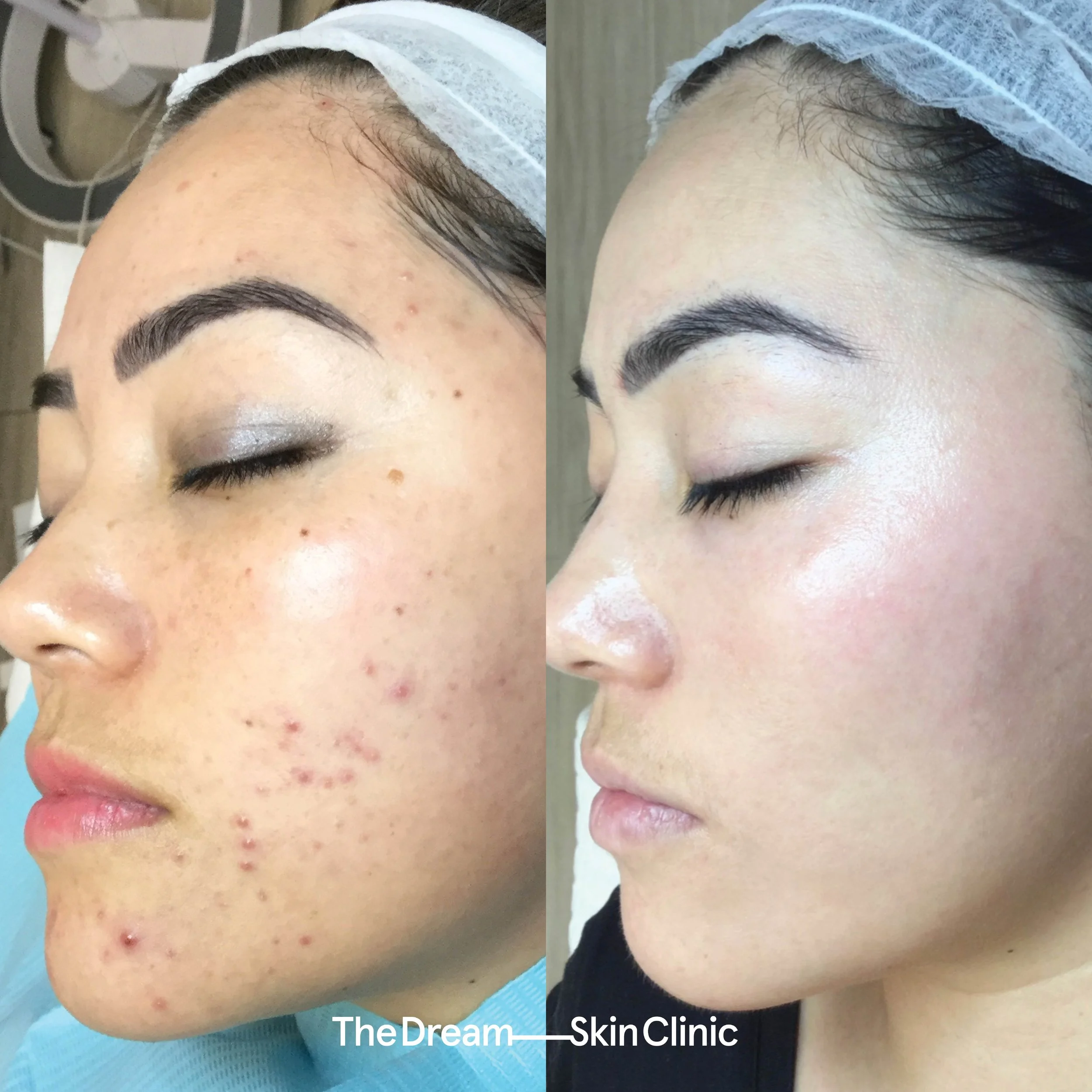 Acne Breakout? Could Your Phentermine Be To Blame? - mio01p2