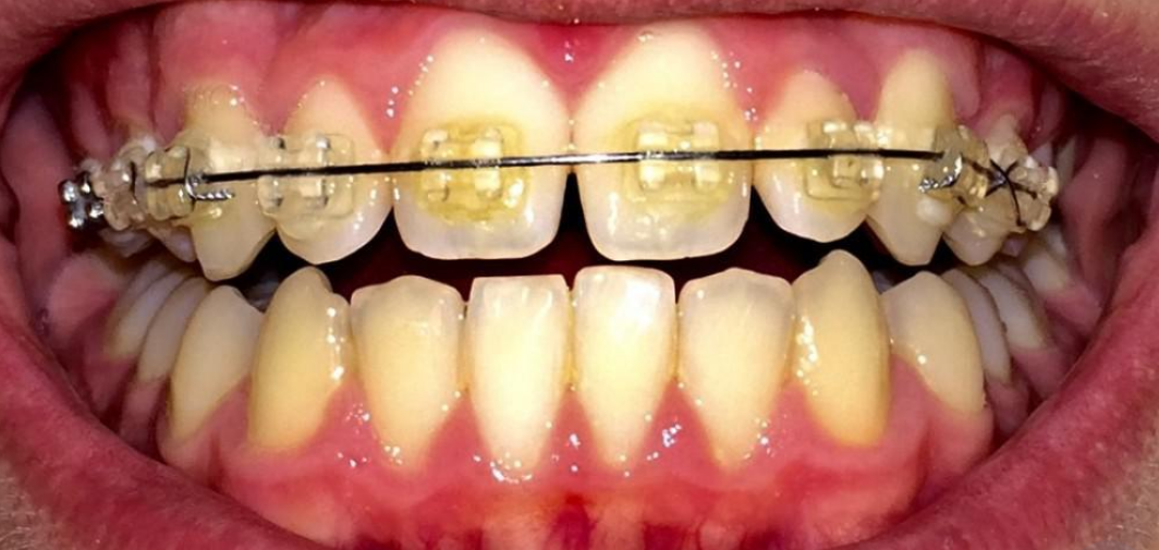 How to Keep Clear Braces From Turning Yellow