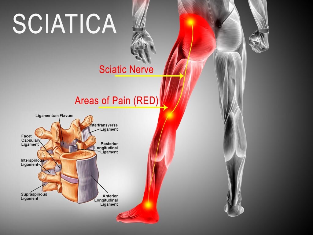 Sciatic Nerve Pain - Silver Chiropractic & Wellness