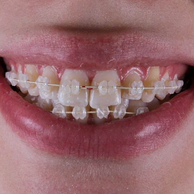 Clarity Advanced by 3M. Pearlescent modules, coated archwires by AO. Smile is models own.

#orthodontics #health #beauty #dentist #dentista #orthodontist #braces