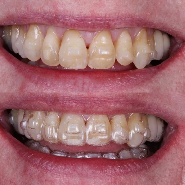 Omnichroma Composite Attachments. 8 months old. Aged dentition - 8 attachments placed with one composite shade still looking great.
#invisalign #orthodontics #dentist #dentista