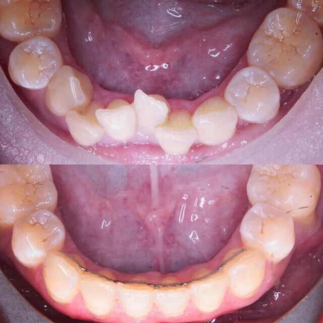 Lower anterior alignment nailed. #bishbashbosh #orthodontics #orthodontie