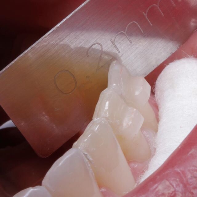 0.2MM Incremental IPR #invisalign #orthodontics