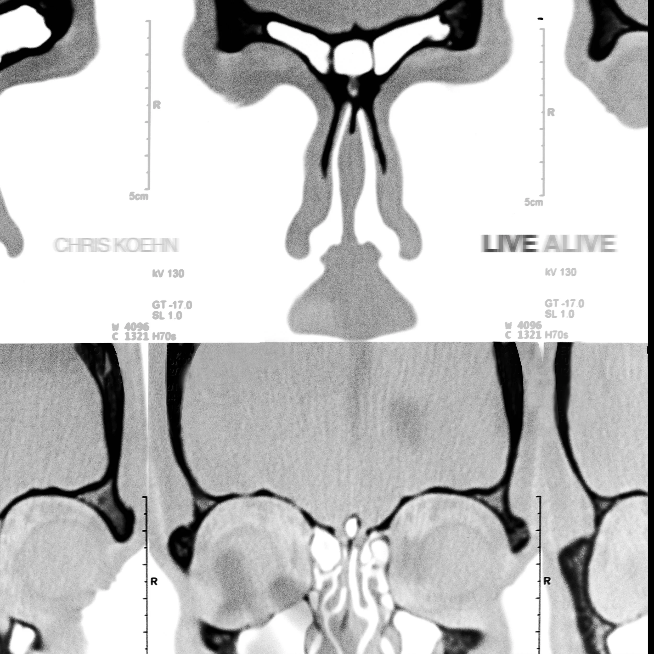 Chris Koehn gets personal on latest track, "Live Alive"