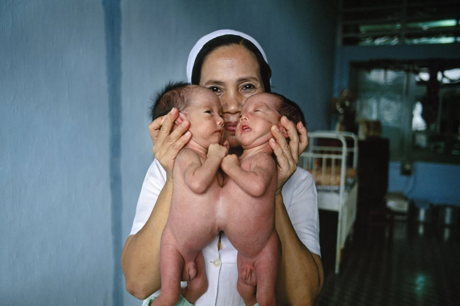 DR. PHUONG, AN OBSTETRICIAN, FAMOUS FOR BEING ONE OF THE FIRST TO NOTICE AN EXCESSIVE NUMBER OF DEFORMED BABIES, DISPLAYS SIAMESE TWINS AT THE TU DO HOSPITAL IN SAIGON, 1990