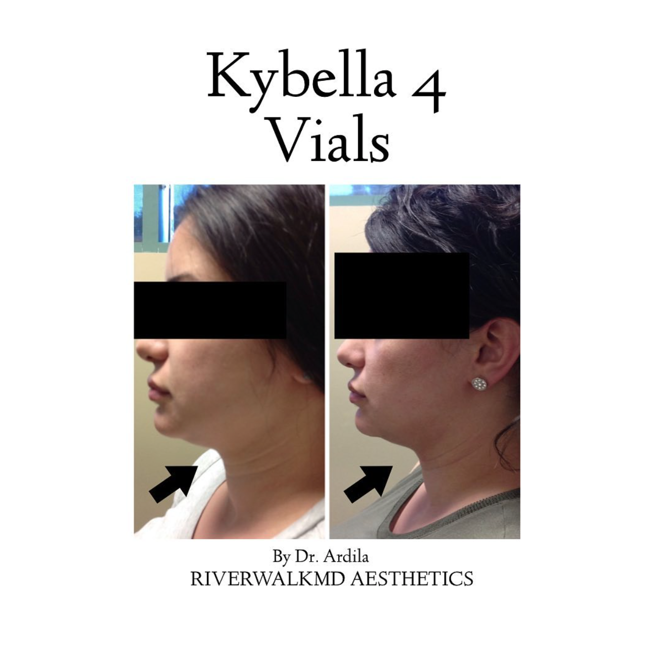 Kybella before & after