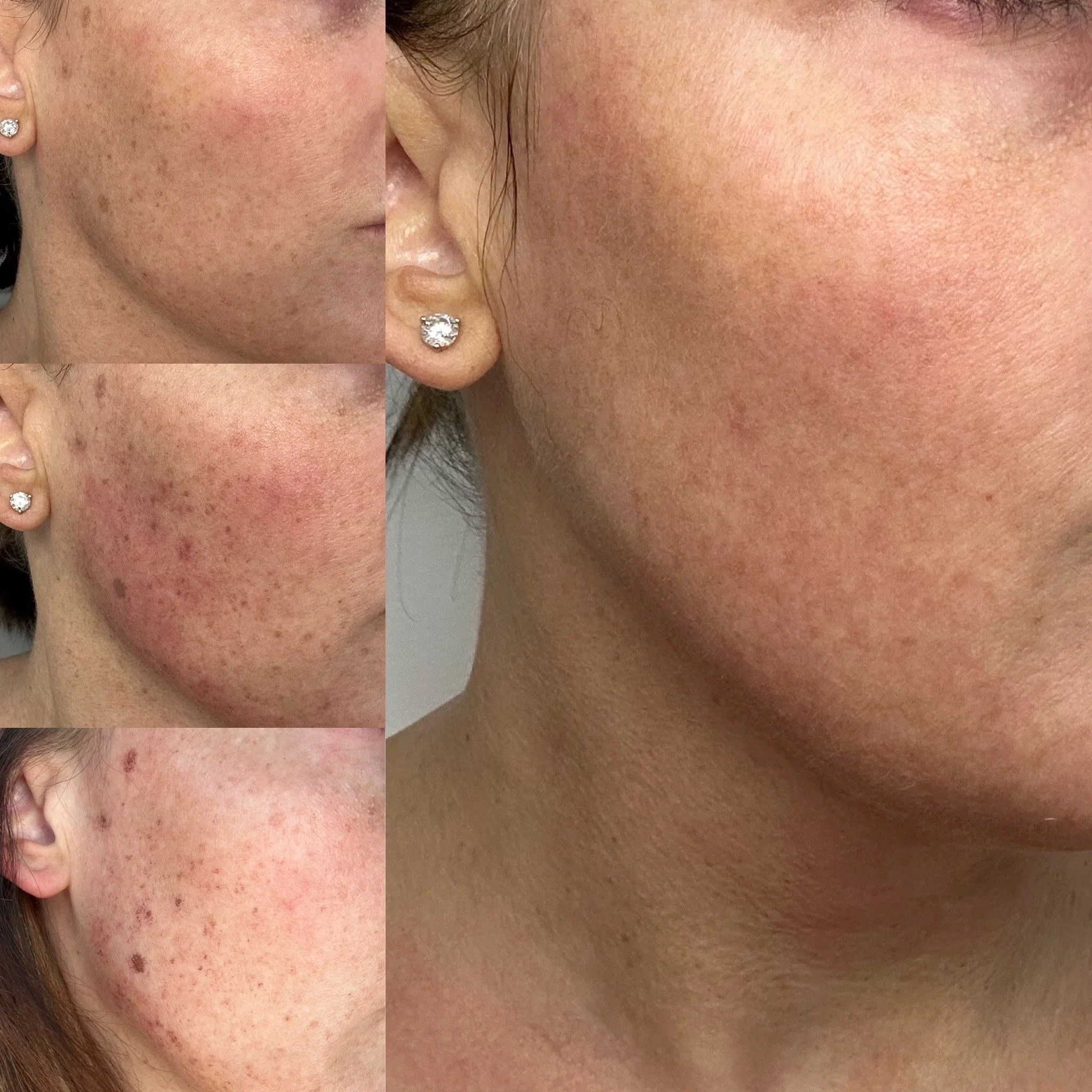 BBL Hero - Before and After by Dr. Steffany Shearer