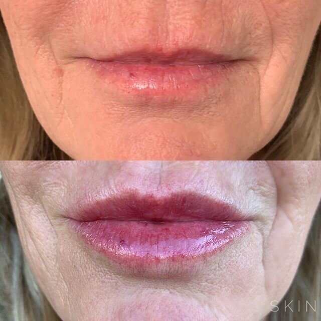 There is a definite art involved when it comes to aesthetic medicine. Without over-injecting, we restored lost lip volume creating a more youthful pout for our patient while keeping things natural and age appropriate!