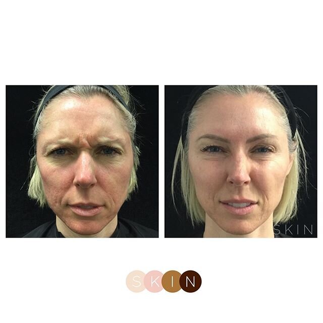 BLOWN AWAY (even though this is what we do for a living)!⁣
⁣⁣
Our patient came in with concerns of looking tired and wanted fresh, glowing skin - so we gave her just that!⁣⁣
⁣⁣
Her appointment started out with a HydraFacial to deeply cleanse her skin