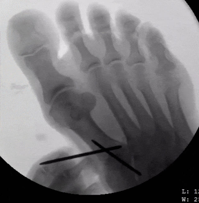 M015-Live-Fluoro-Met-Rotation-compressed.gif