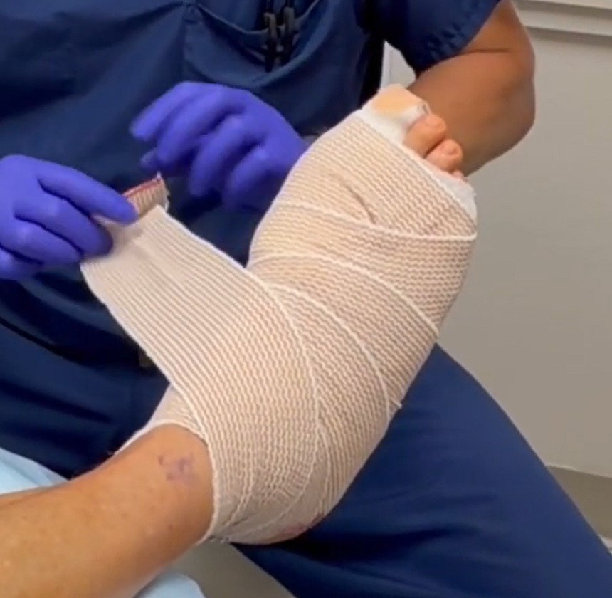 Do I Change My Bandage After Bunion Surgery?  The 3D Bunion Doc Explains If, When and How a Bandage Should Be Changed