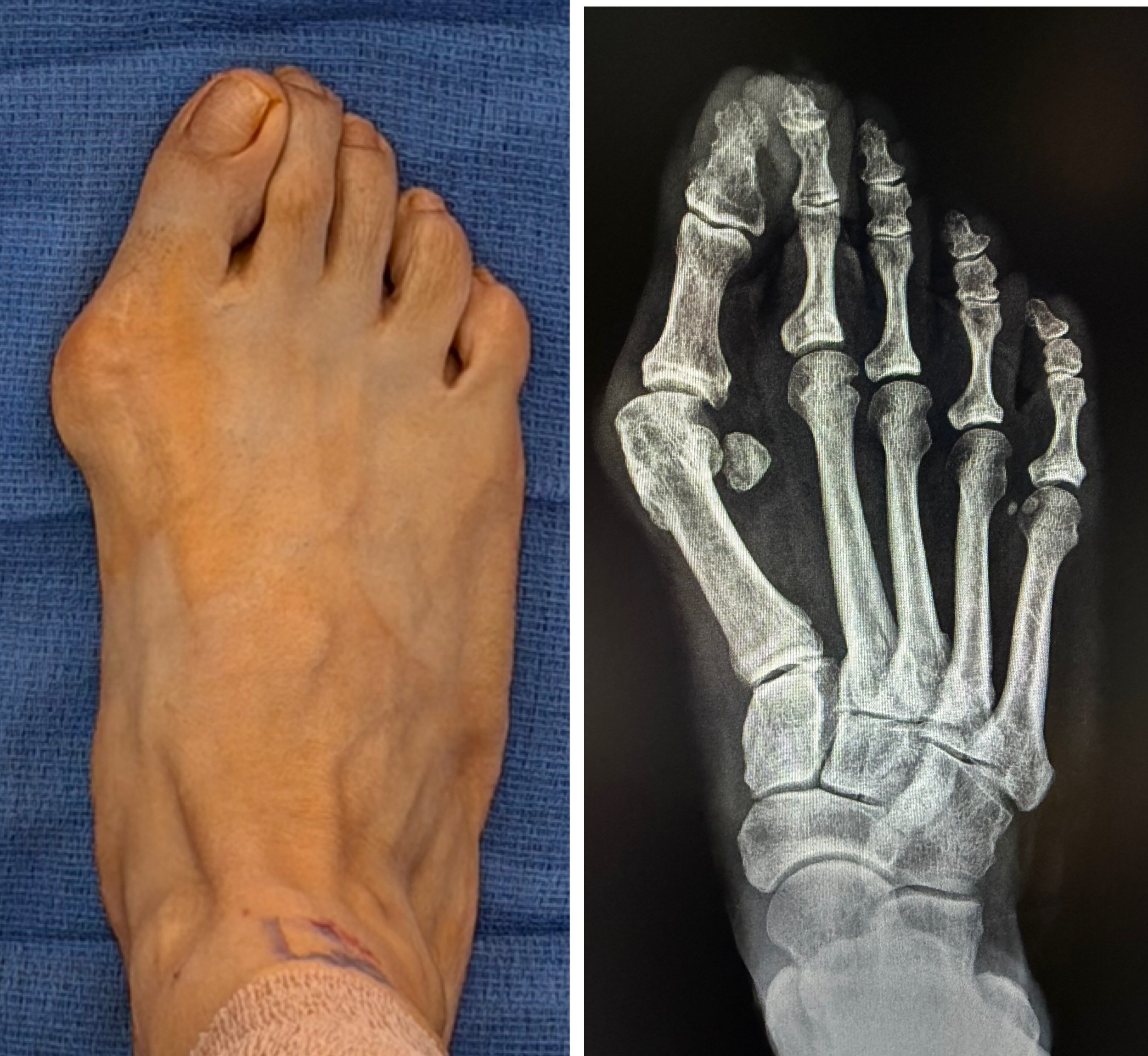 Do Bunions Get Worse? What You Can Do to Slow Bunion Progression