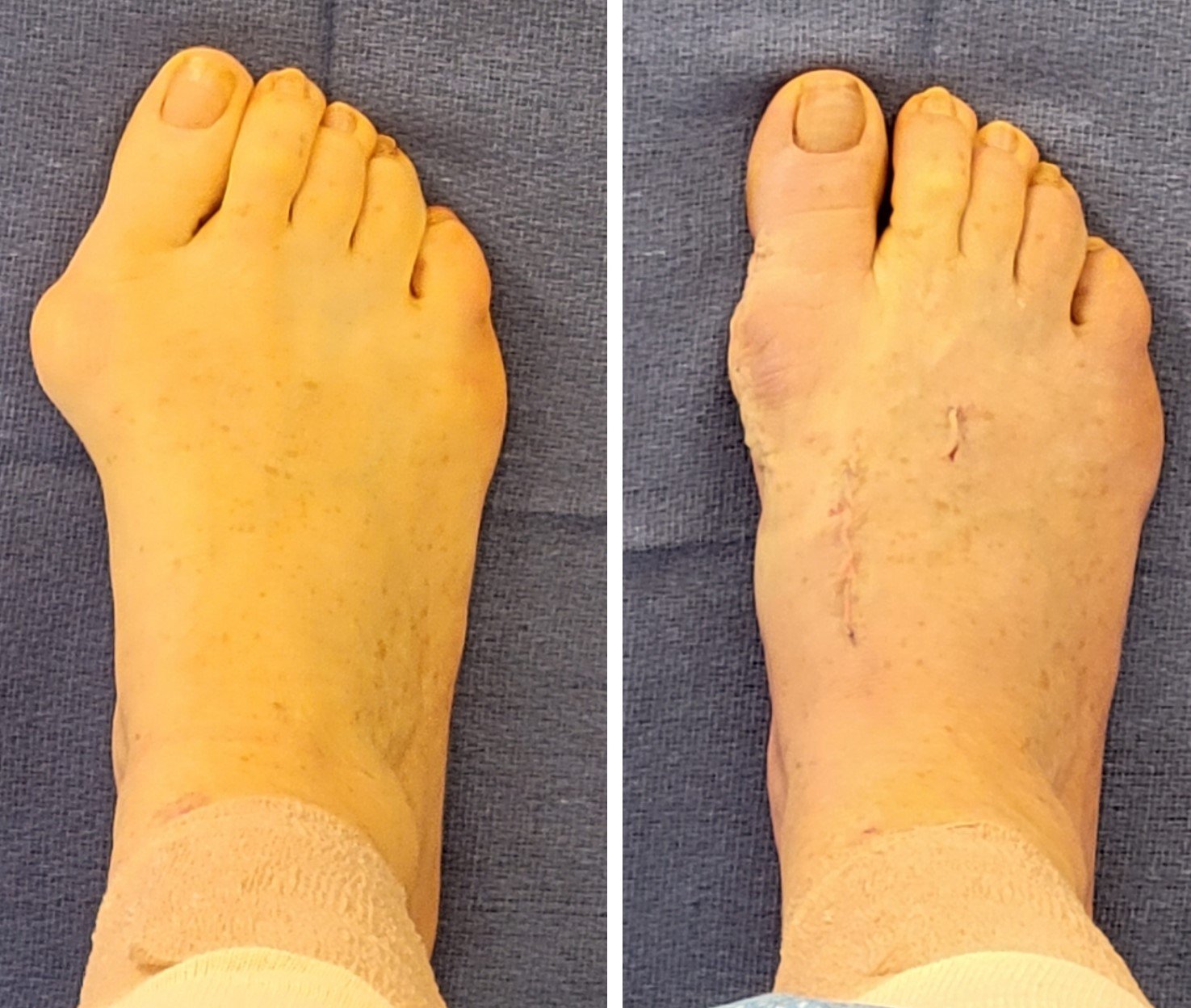 How To Reduce Scarring After Bunion Surgery — Dr Paul Steinke