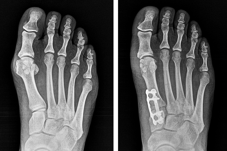 How Much Does Bunion Surgery Cost? Comprehensive guide to all surgery