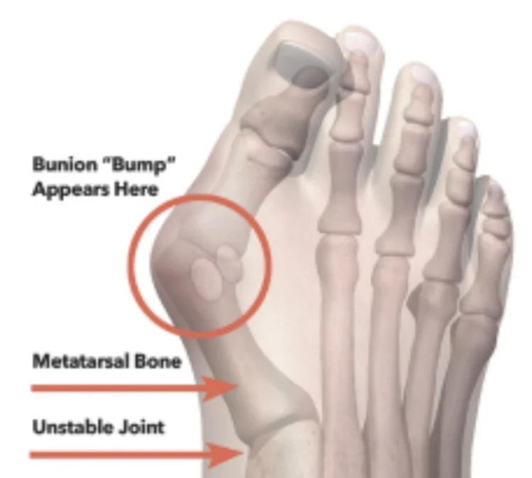 Mis Incision What are the differences between MIS(Minimal Incision) Bunion Surgery ...
