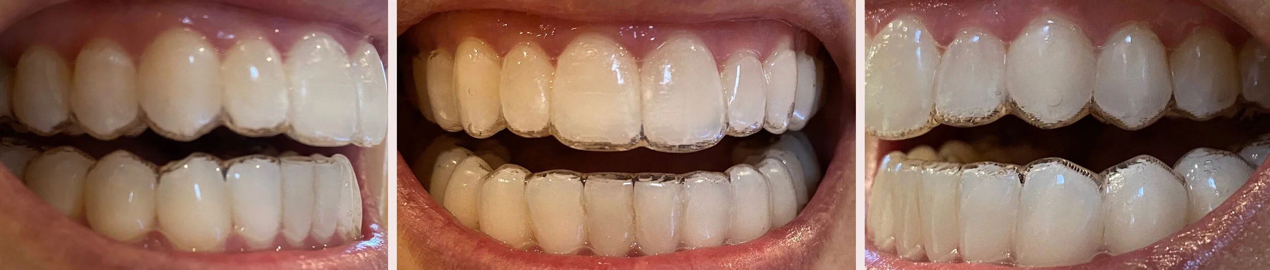 invisalignalignerteeth.jpg