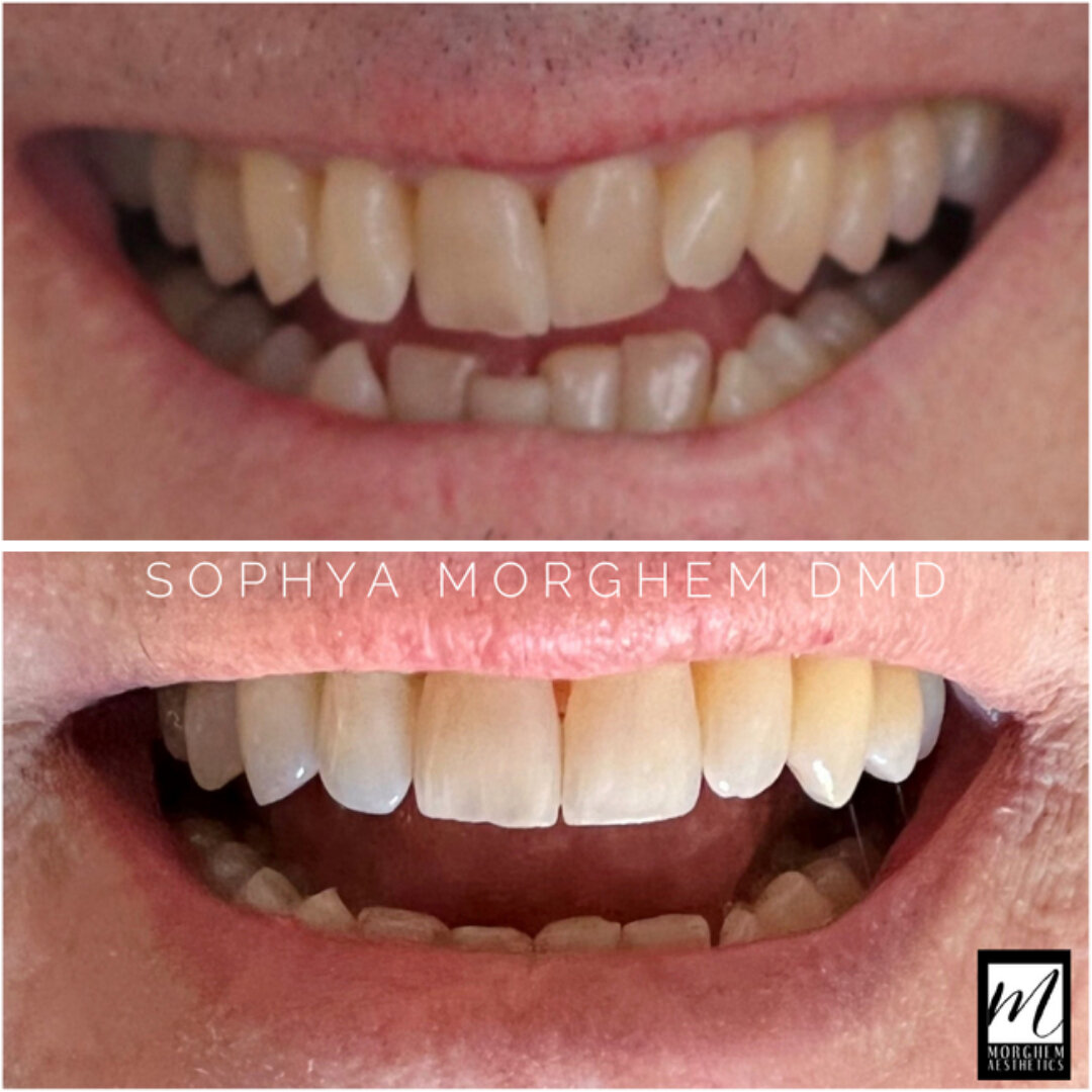 🌟SMILE TRANSFORMATION 🌟

This patient came in hating the look of his smile with crooked and uneven teeth.  It was even more noticeable when talking during video meetings. 

After a little Invisalign, this patient is 