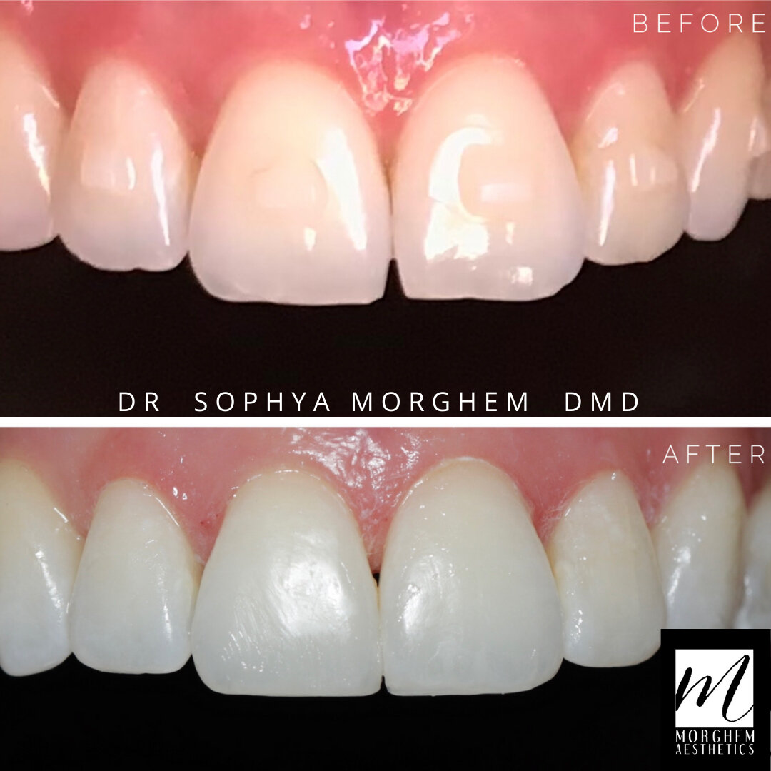🌟SMILE TRANSFORMATION 🌟 A little conservative composite bonding to freshen up this smile. This involves NO enamel reduction and NO numbing! Same day treatment for composite bonding is a great way to revamp your smile. 😃 