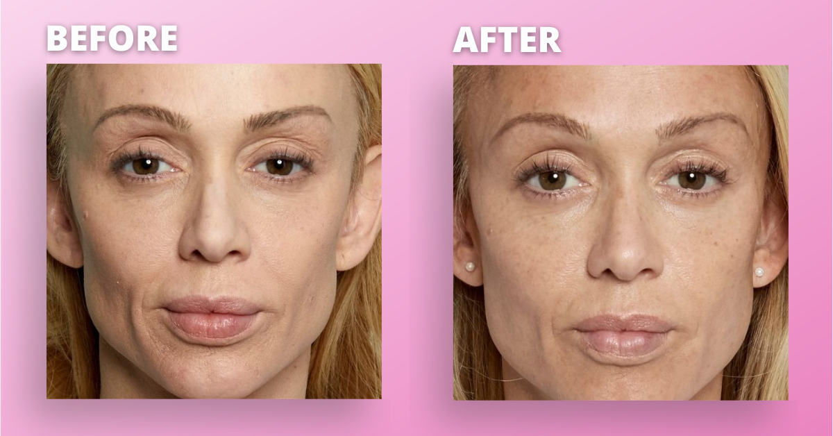 11 Amazing Benefits of Sculptra | Beauty and Anti-Aging Filler Treatment