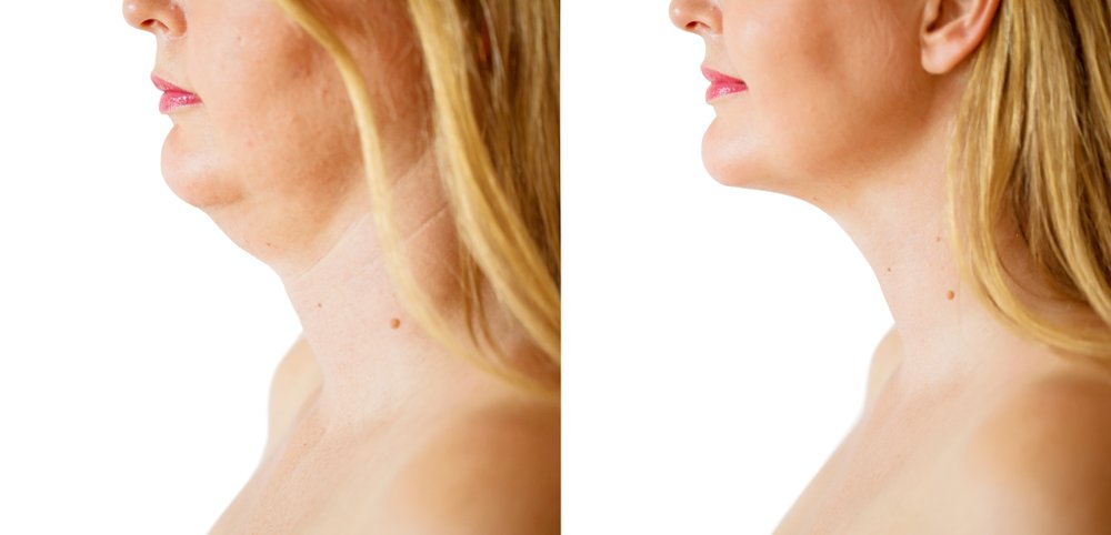 Kybella Before and After: What Results You Can Expect for Double Chin Removal
